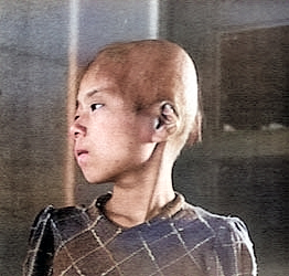 This 11-year-old Japanese girl, a surivor of the atomic bombing of Hiroshima, Japan, suffered hair loss, fever, and bleeding gums from radiation poisoning, 1945 [Colorized by WW2DB]