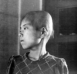 This 11-year-old Japanese girl, a surivor of the atomic bombing of Hiroshima, Japan, suffered hair loss, fever, and bleeding gums from radiation poisoning, 1945