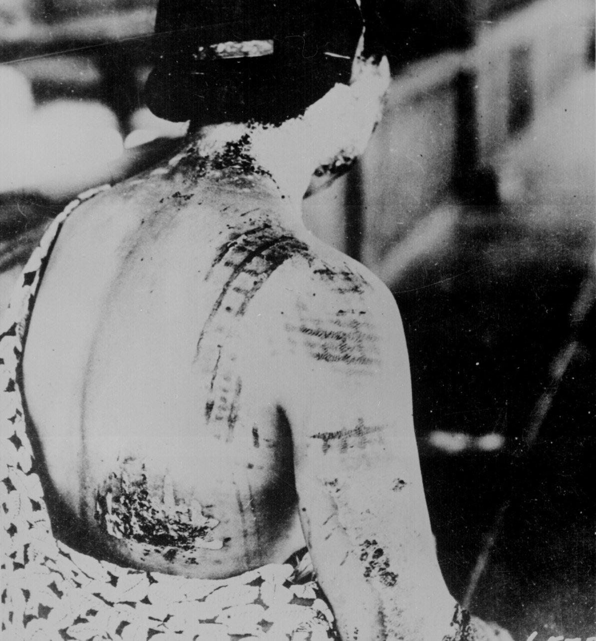 The atomic bomb survivor's skin was burned in a pattern corresponding to the dark portions of her kimono worn at the time of the explosion, Aug 1945